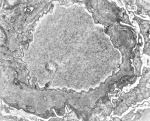 F,49y. | membranous glomerulopathy F,49y. | membranous glomerulopathy